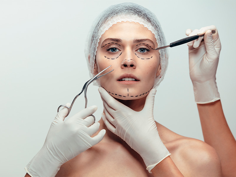 Imagem de uma mulher com marcações faciais antes de se submeter ao lifting facial.