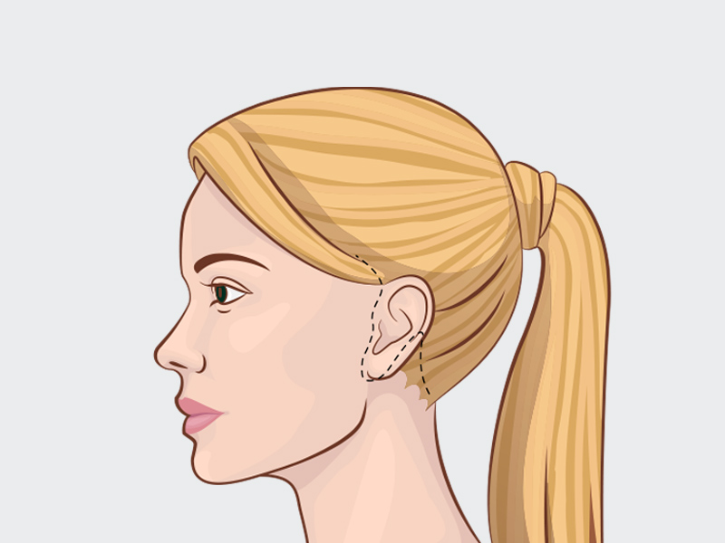 Ilustração de uma mulher com marcações no local onde fica a cicatriz do lifting de pescoço