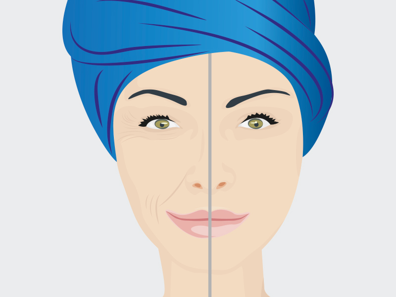 Ilustração exemplificando o antes e depois do lifting facial