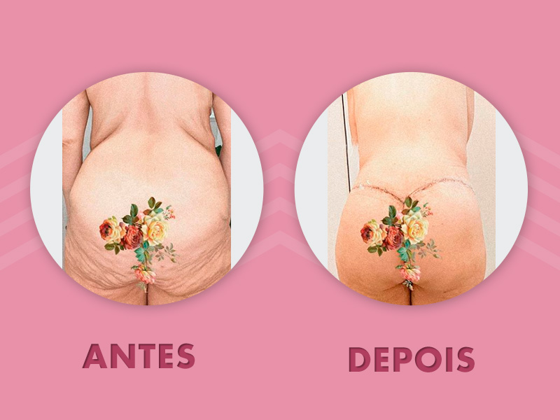 Imagem com o antes e depois da torsoplastia de uma paciente mulher