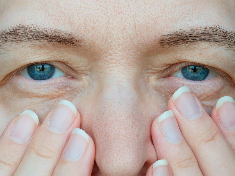 Imagem de uma mulher com o olhar visivelmente caído, pensando em realizar um lifting de sobrancelhas