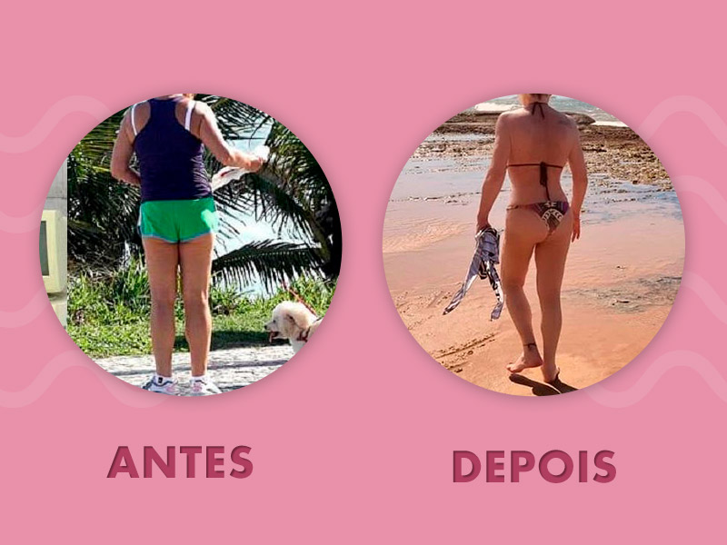 gluteoplastia antes depois ana maria braga