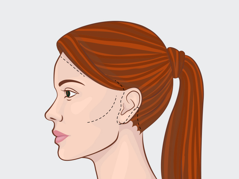 Ilustração de uma mulher de perfil e com marcações nos locais de incisão do lifting facial