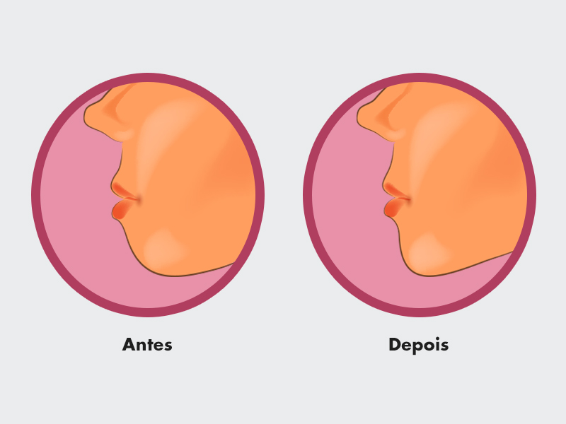 Ilustração para mostrar o antes e depois da mentoplastia 