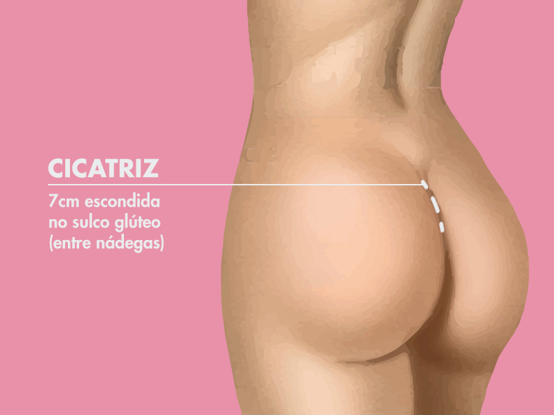 Saiba como fica a cicatriz da Gluteoplastia. cicatriz gluteoplastia