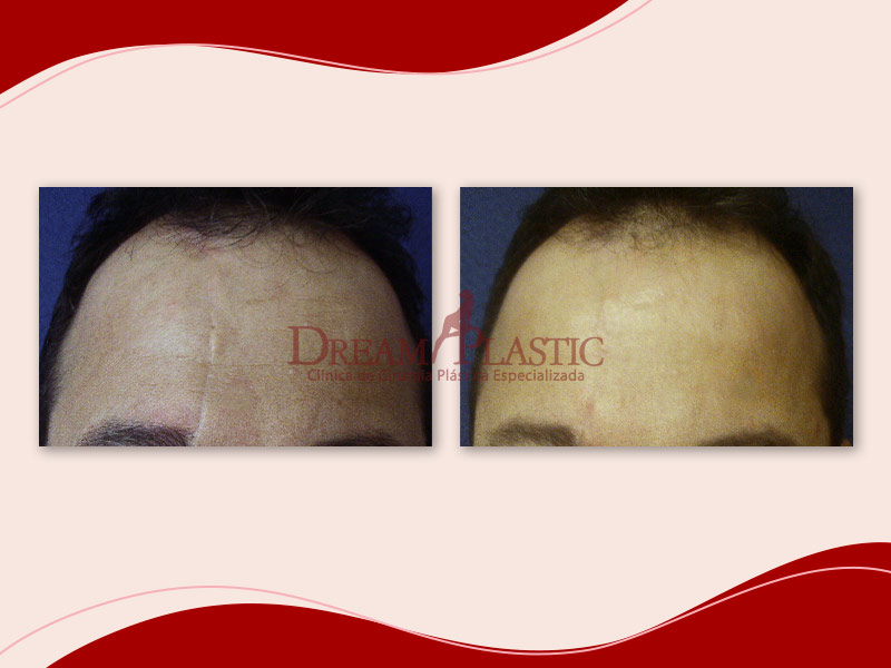 Antes e depois da cirurgia para remover a cicatriz na testa de paciente