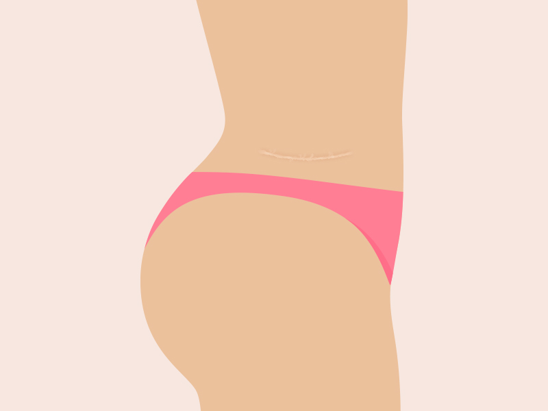 Ilustração de mulher de lado, para mostrar a cicatriz da flancoplastia, uma linha horizontal embaixo da cintura na lateral do corpo