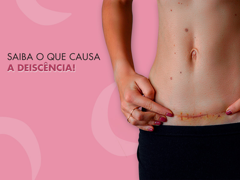 Deiscência: Saiba o que causa a abertura da sutura e como cuidar dos pontos inflamados deiscencia