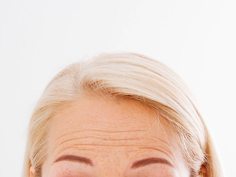 Imagem de uma mulher com linhas finas na testa, causadas principalmente pelos movimentos repetitivos da face e pelas nossas expressões faciais