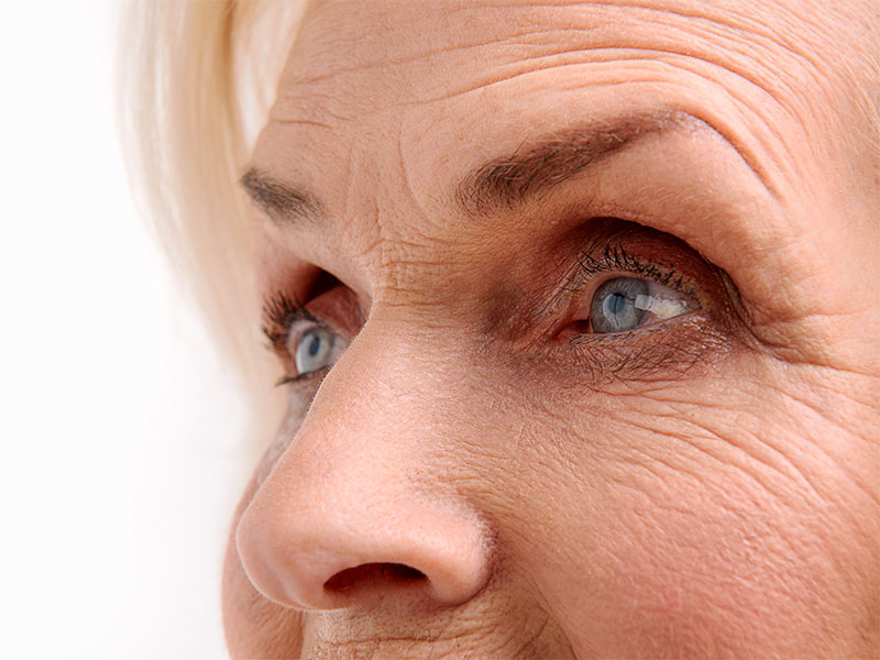 Imagem de uma mulher com diversas rugas finas na região dos olhos e da testa