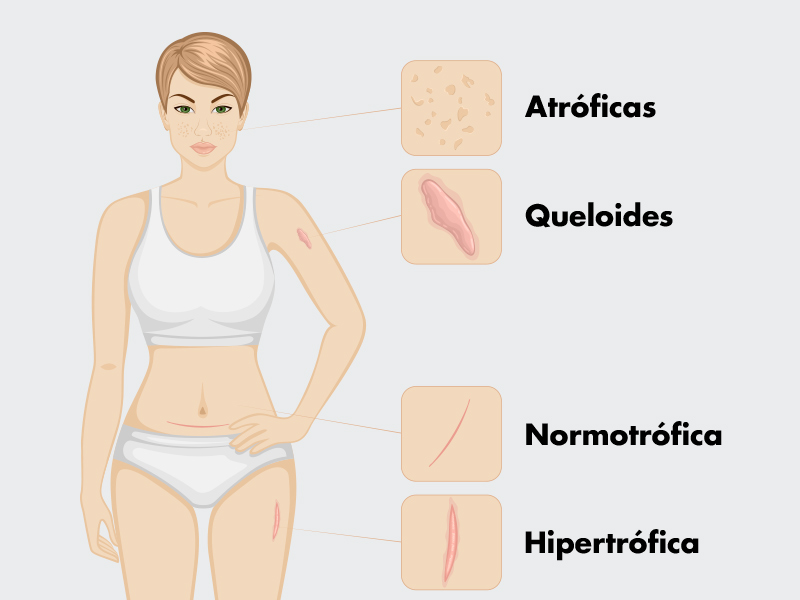 tipos cicatrizacao