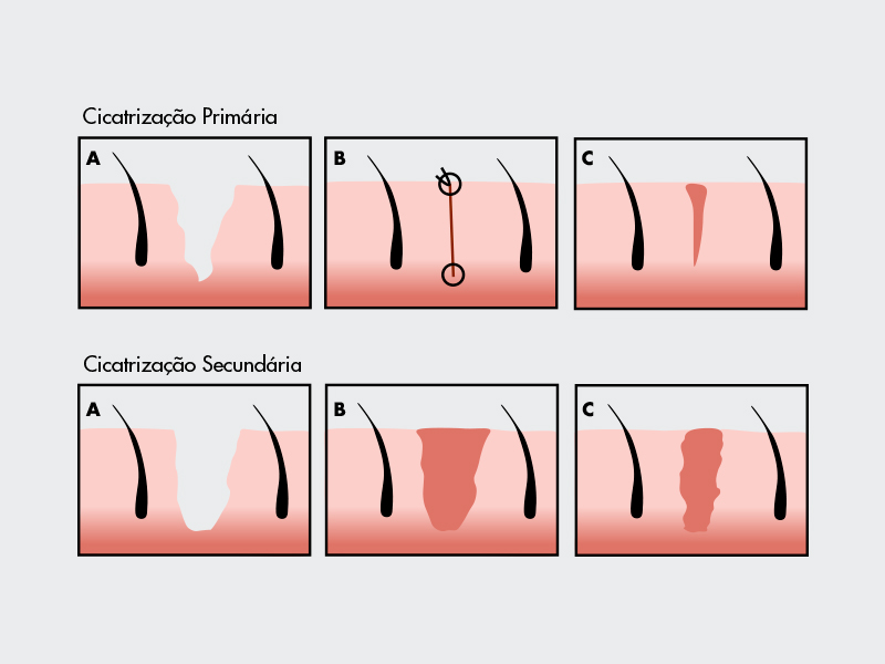 tipos cicatrizacao