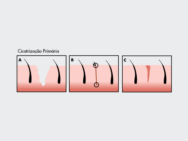 cicatrizacao primeira intenacao