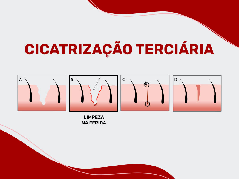 Ilustração que mostra como ocorre a cicatrização terciária