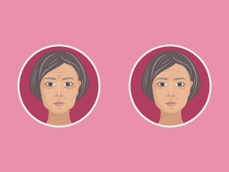 Ilustração do rosto de uma mulher com o antes e depois do mini lifting de rosto e pescoço