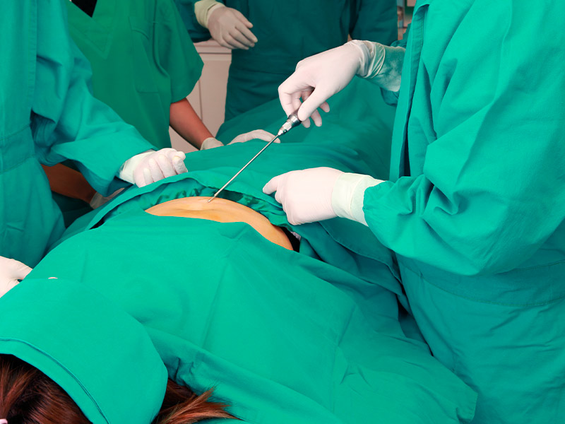 Como é feita a cirurgia de lipoaspiração? como feita cirurgia