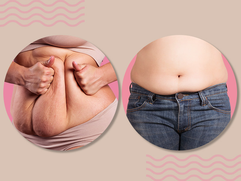 Abdominoplastia X Lipoaspiração veja diferenca entre procedimentos