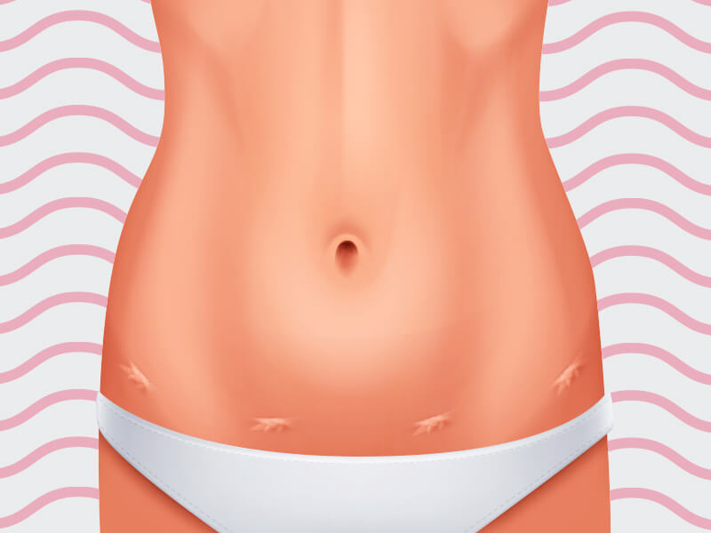 Ilustração exemplificando como fica a cicatriz da lipoaspiração