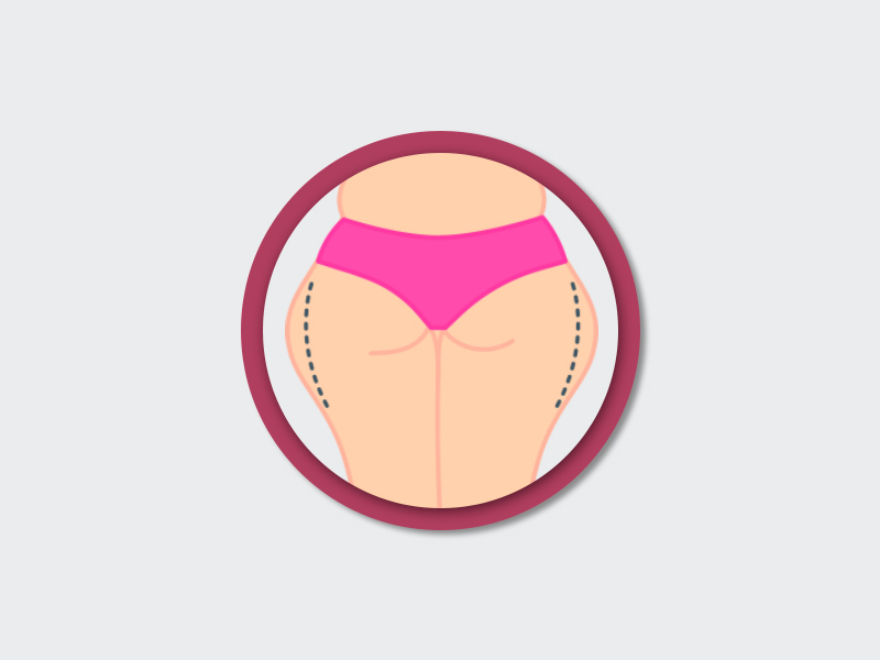 Lipo nos culotes lipo culotes