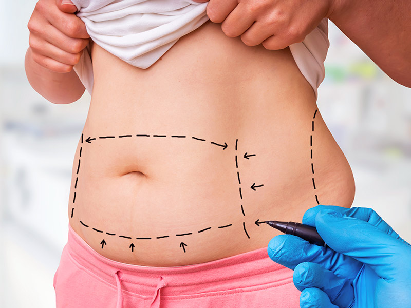 Qual o limite de gordura retirada da lipoaspiração? saiba quanto gordura voce pode tirar