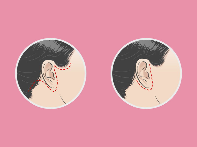 Ilustração indicando onde ficam as cicatrizes do mini lifting ao redor da orelha e próximo do couro cabeludo