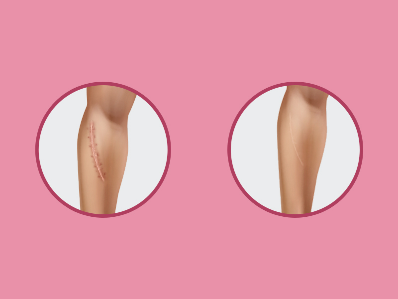 Como tirar cicatrizes? Duas ilustrações da correção da cicatriz antes e depois