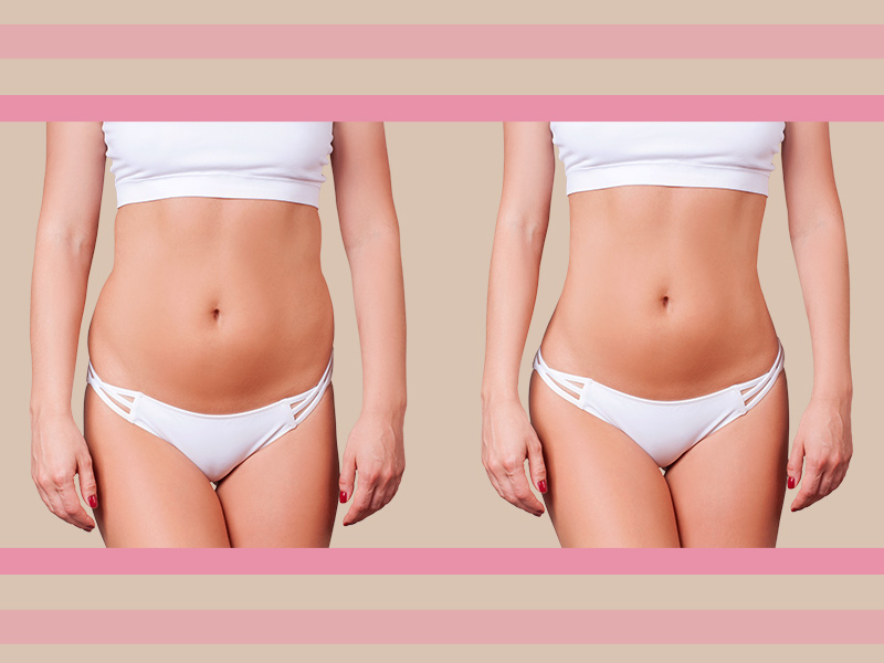 Lipoaspiração antes e depois: onde ver resultados? fotos antes depois