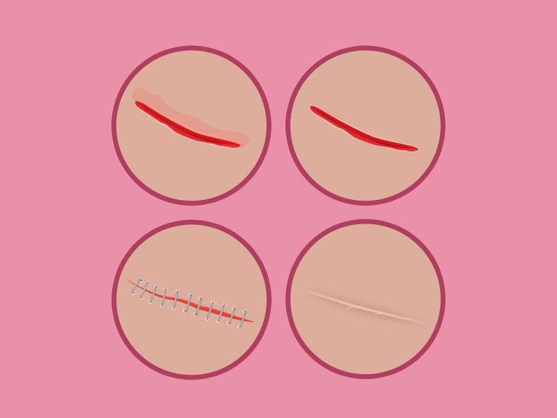 Qual o melhor tratamento para cicatrizes? Ilustração com o passo a passo da cirurgia plástica para cicatriz