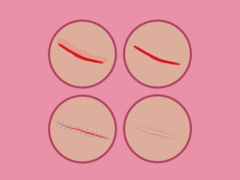 Ilustração com o passo a passo da cirurgia plástica para cicatriz