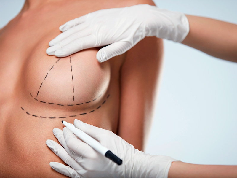 O que é a prótese de silicone? mulher com marcação de prótese silicone