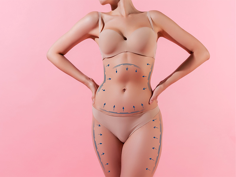 Lipoaspiração ou Lipoescultura: qual a diferença entre as duas? corpo marcado lipoescultura