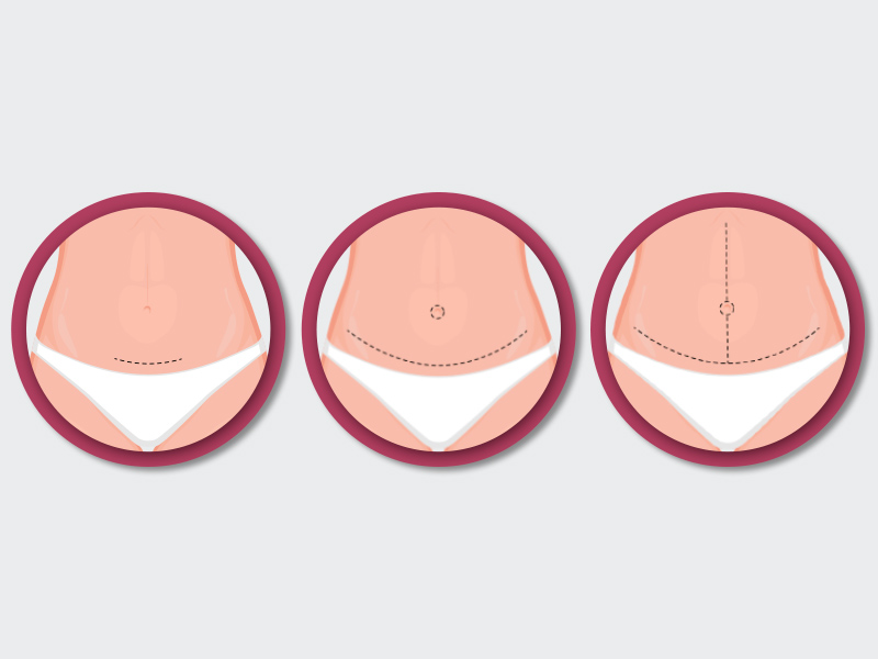 ilustração com os principais tipos de abdominoplastia