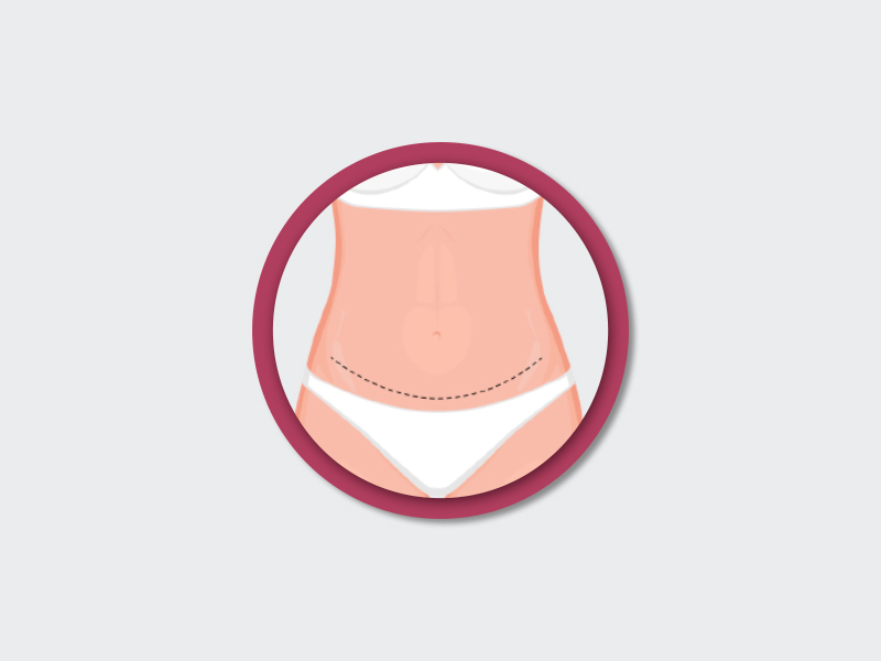 Incisão acima do púbis ilustração da cicatriz da cirurgia plástica na barriga