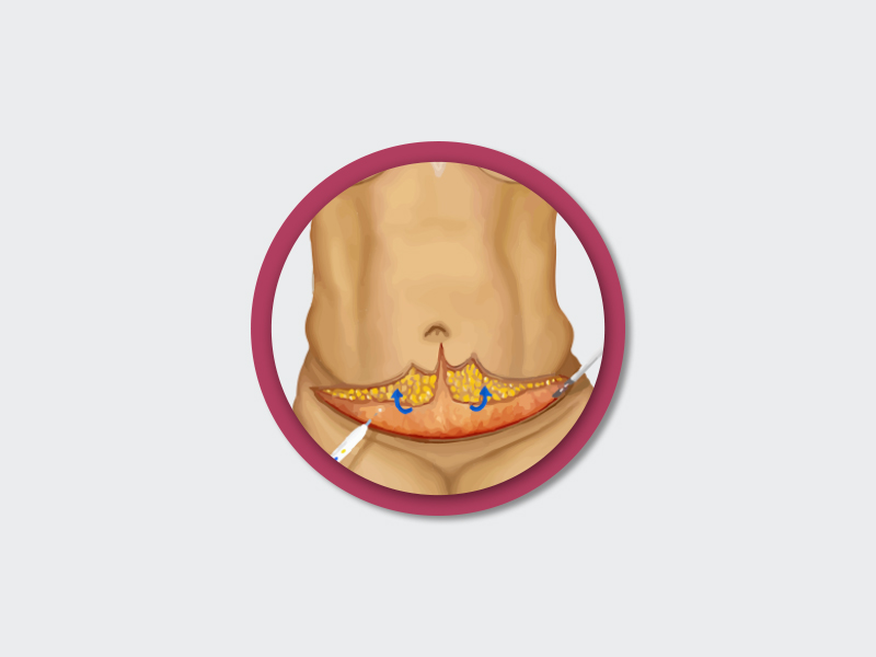 ilustração mostrando a plástica barriga