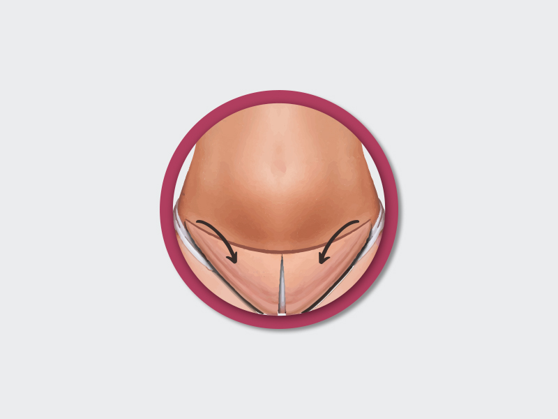 passo a passo da cirurgia barriga abdominoplastia