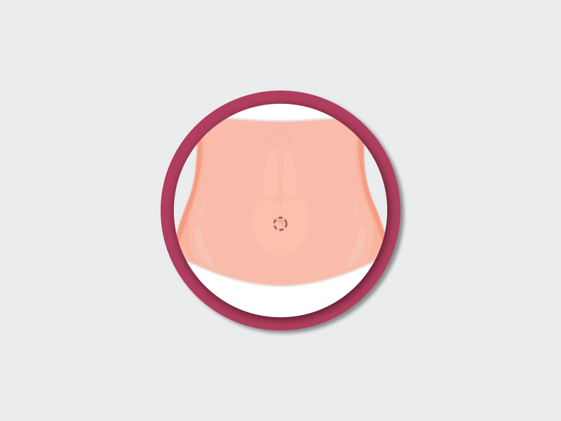 ilustração de como fica o umbigo na cirurgia plástica abdominal