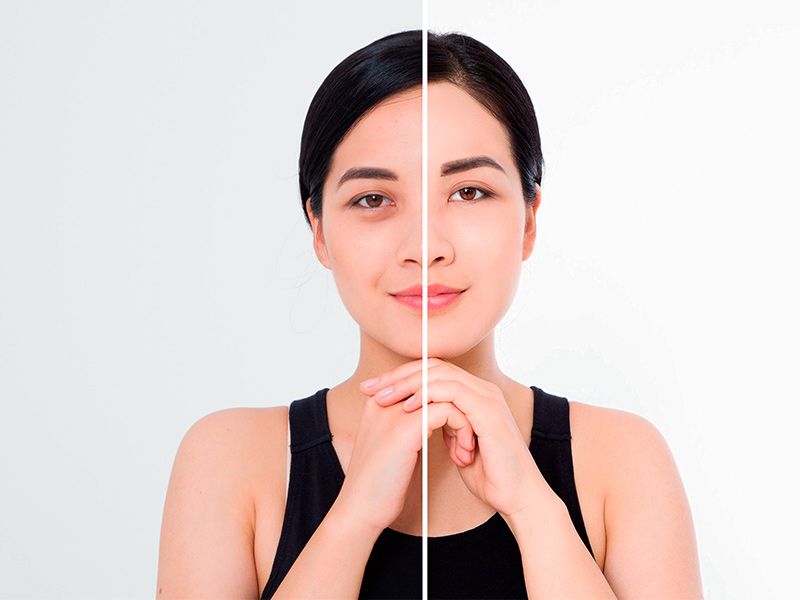 Antes e depois do preenchimento das olheiras em mulher
