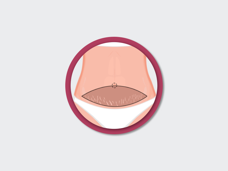ilustração mostrando que a cirurgia plástica abdominoplastia também retira as estrias