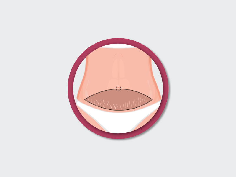 As estrias da região são removidas. ilustração mostrando que a cirurgia plástica abdominoplastia também retira as estrias