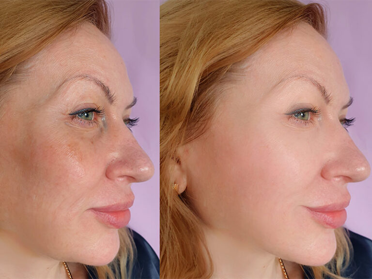 Preenchimento Do Malar Antes E Depois Preenchimento Facial e de Olheiras | Dream Plastic