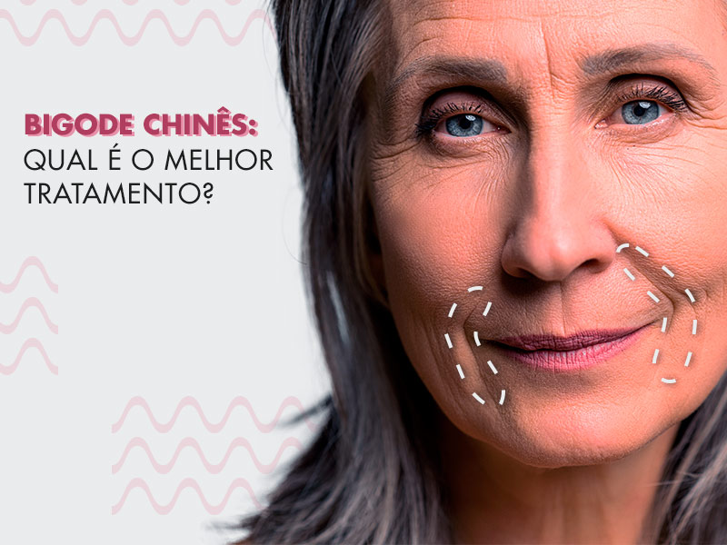 Bigode Chinês: como é feito o preenchimento do sulco nasogeniano e fotos de antes e depois