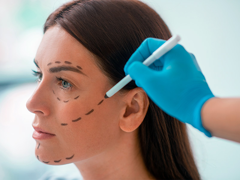 Imagem de um profissional realizando marcações no rosto de uma paciente antes de realizar o procedimento. É importante saber o que é harmonização facial e suas técnicas. 