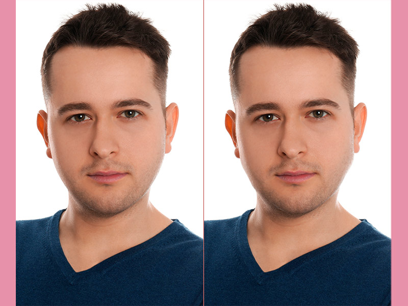 Imagem mostrando o antes e depois da harmonização facial masculina.