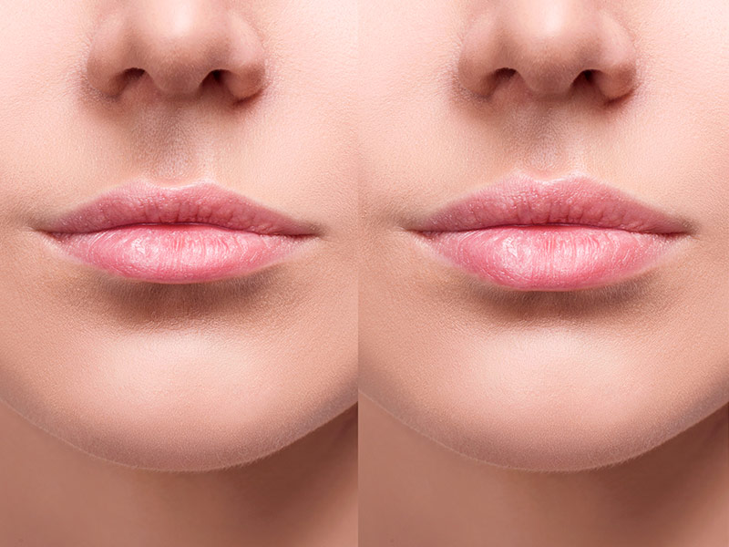 antes e depois do preenchimento labial de 1 ml em uma mulher com lábios finos