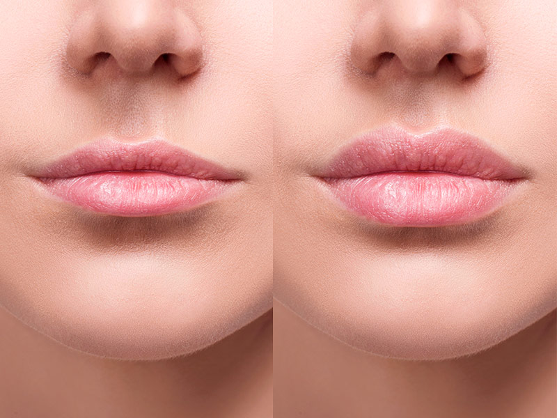 antes e depois do preenchimento labial de 2 ml