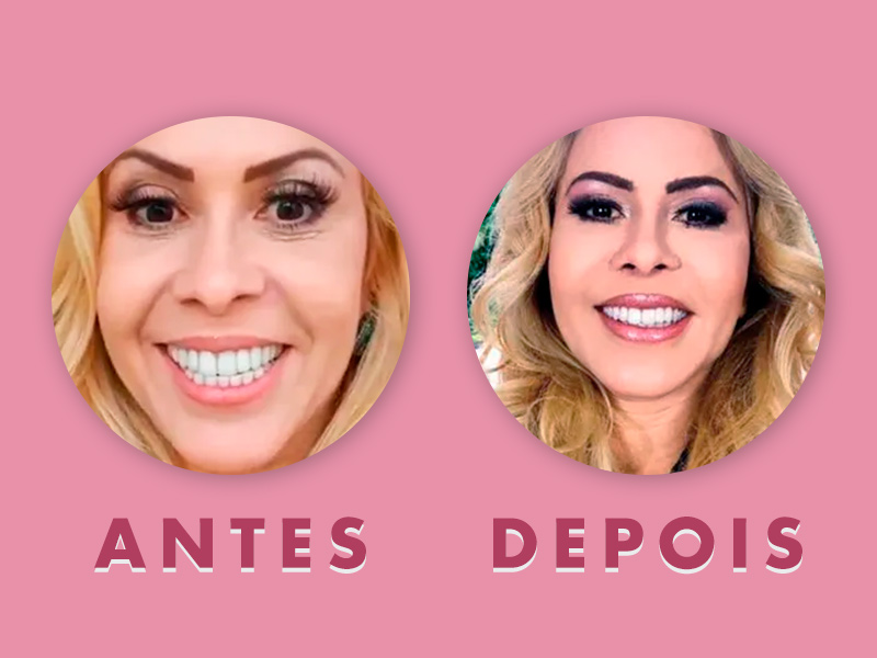 Antes e depois do preenchimento da Joelma