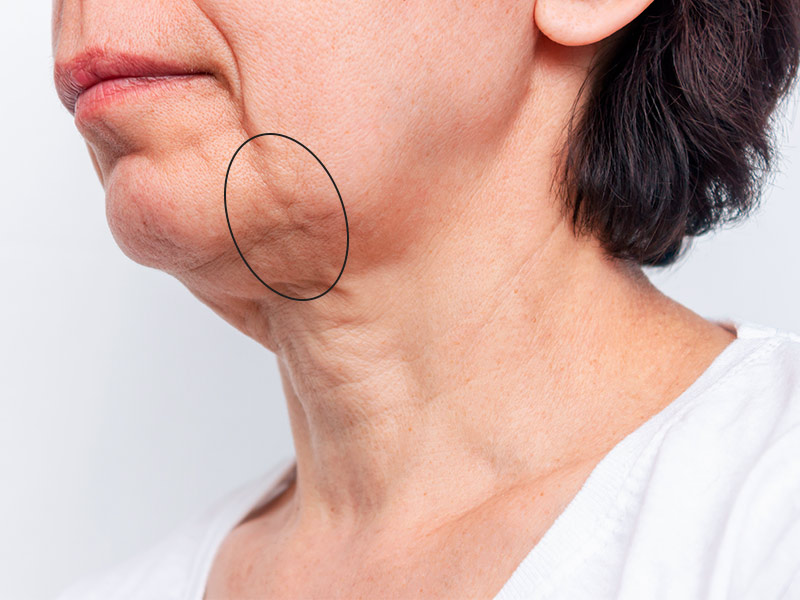 Imagem de uma mulher idosa com perda do contorno da mandíbula