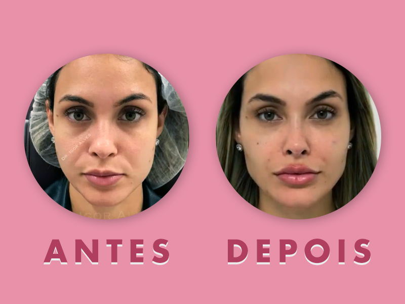 Antes e depois do preenchimento facial da Sarah Andrade