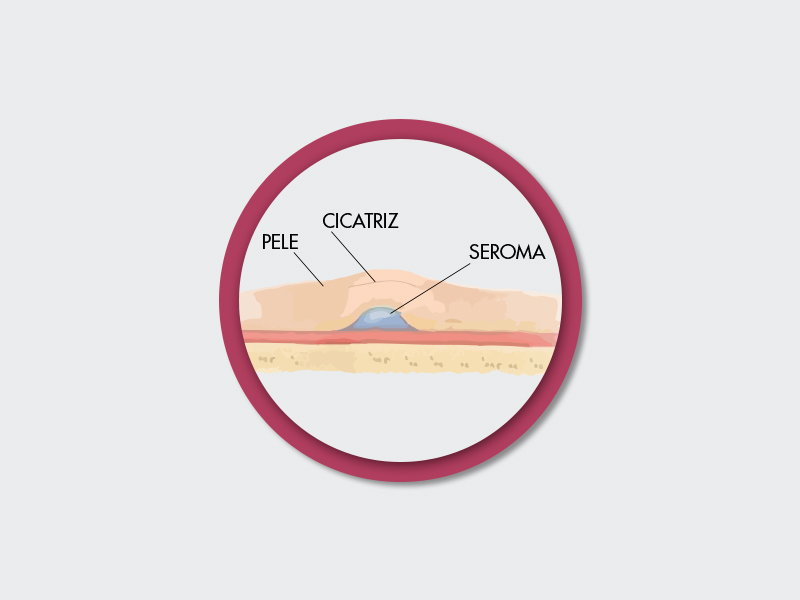 Ilustração que mostra o seroma pós mamoplastia redutora