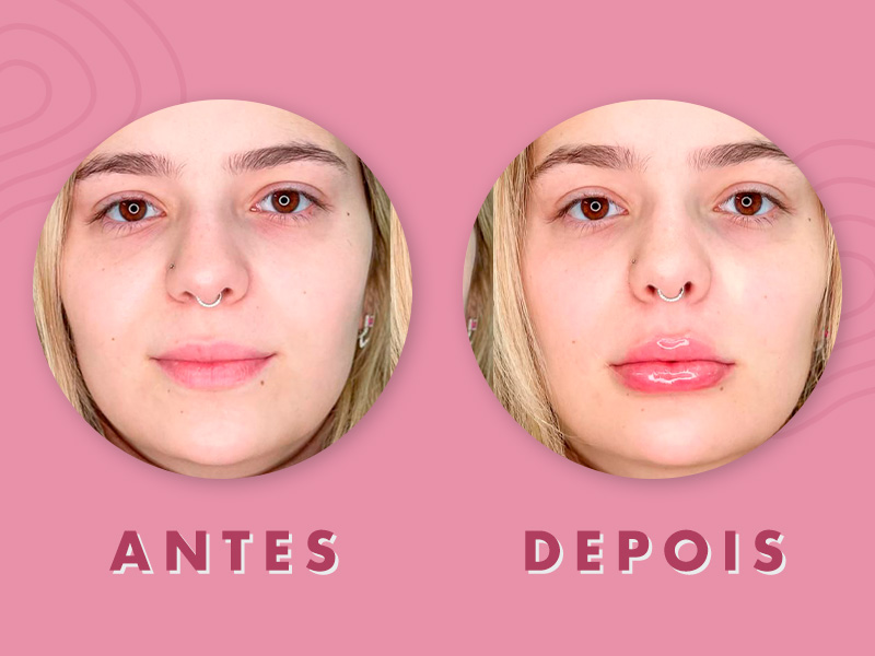 Antes e depois do preenchimento labial da Viih Tube